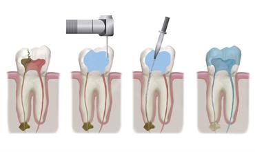 مراحل هشت گانه عصب کشی دندان